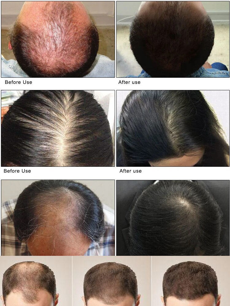 Effective Baldness Fast Hair Growth Oil